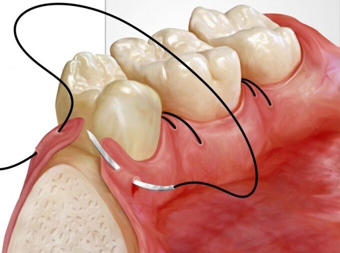 Chirurgie orală